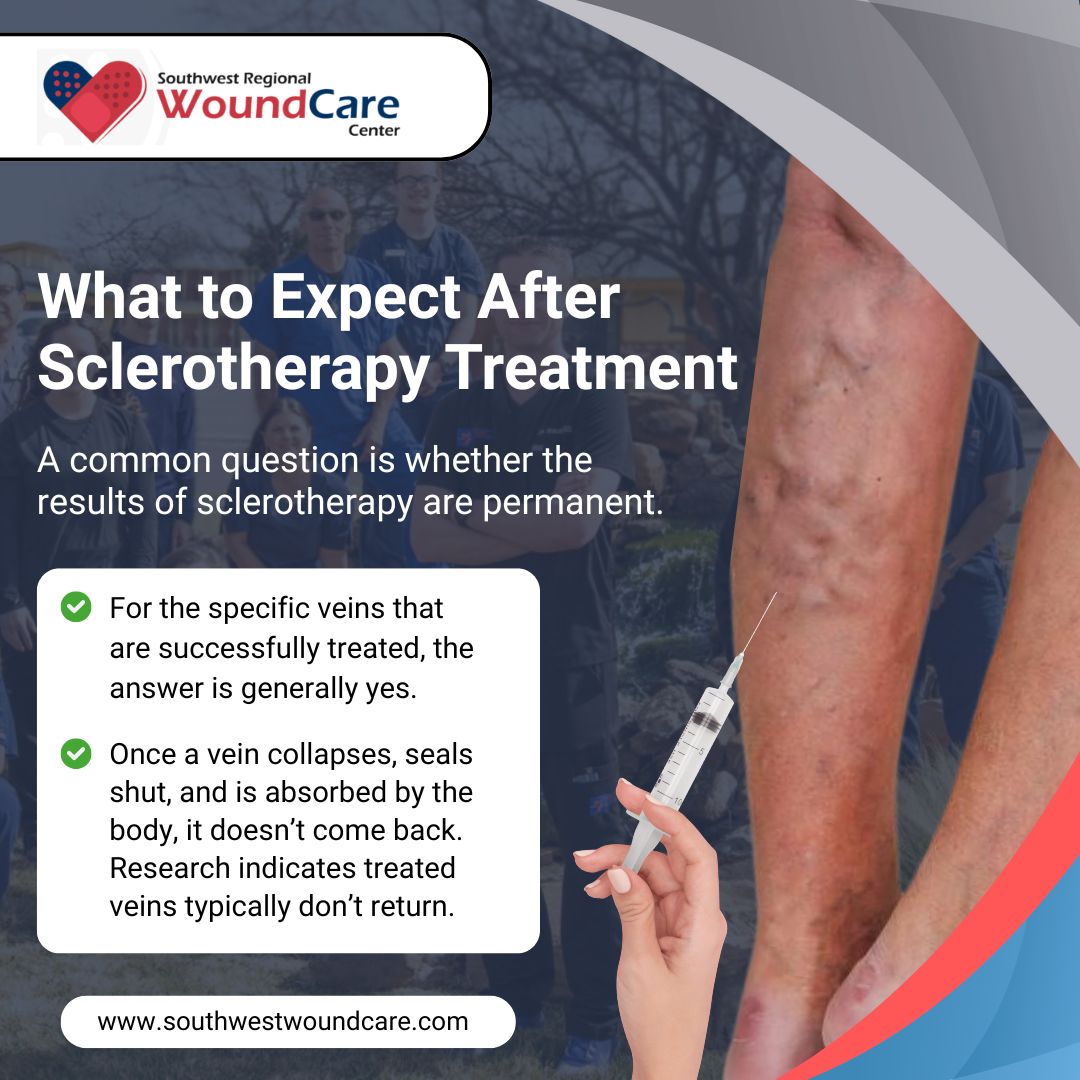 What to Expect After Sclerotherapy Treatment