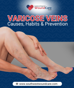 Varicose Veins – Causes, Habits & Prevention